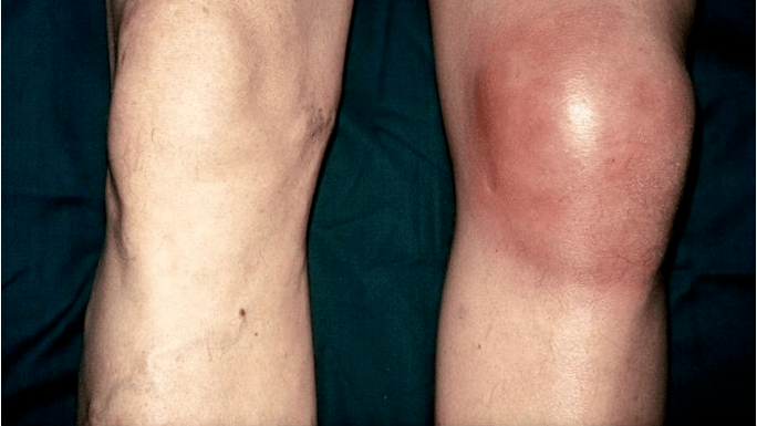 Arthritis and arthritis
