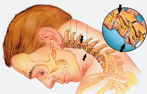 Stages of osteochondral bone marrow disease in the cervical vertebrae